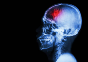 Stroke Awareness Month-Alameda Post Story-Featured